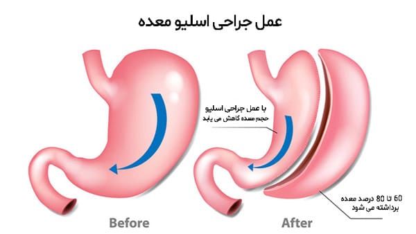 بهترین جراح اسلیو معده در اهواز