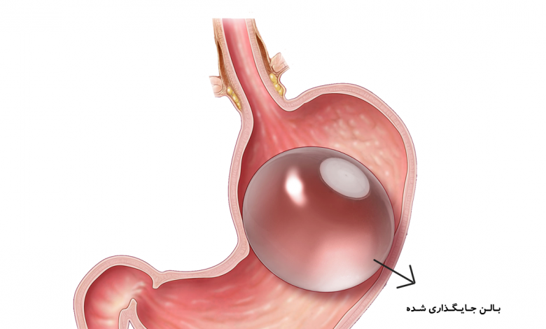 عمل بالن معده