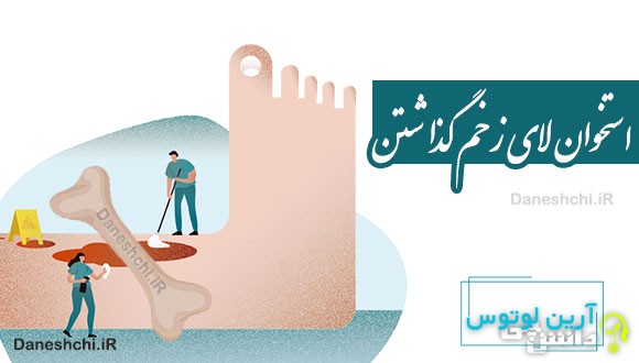 استخوان لای زخم گذاشتن