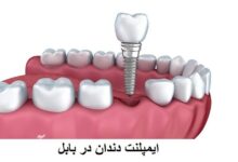 لیست دکتر ایمپلنت دندان بابل