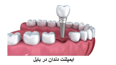 لیست دکتر ایمپلنت دندان بابل
