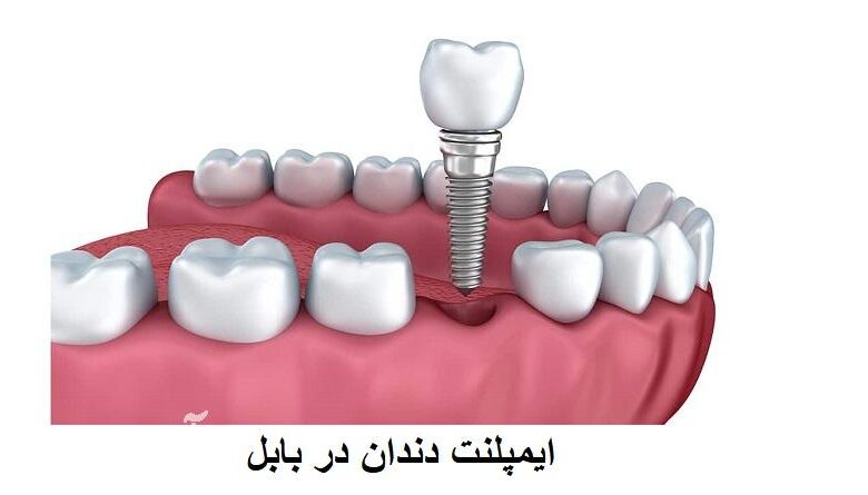 لیست دکتر ایمپلنت دندان بابل