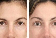 قبل و بعد از لیفت ابرو