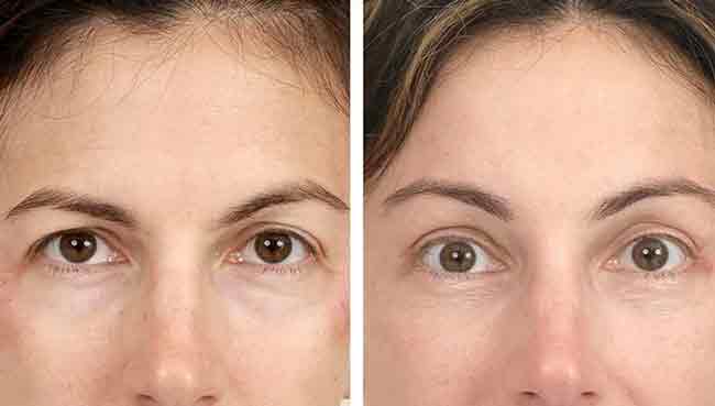 قبل و بعد از لیفت ابرو