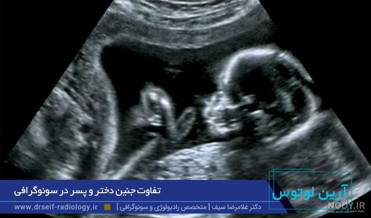 تشخیص جنسیت جنین از روی عکس و فیلم
