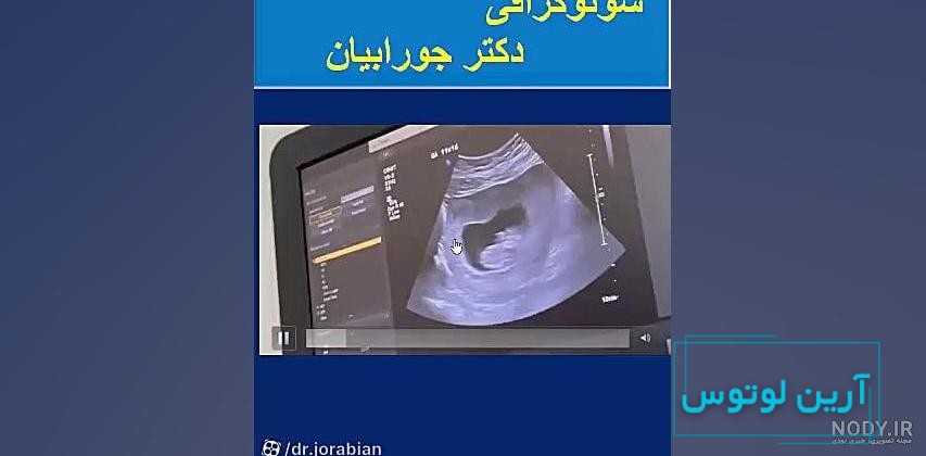 تصاویر سونوگرافی در سه ماهه ی دوم بارداری - هفته چهاردهم تا هجدهم -  سونوگرافی صدرا