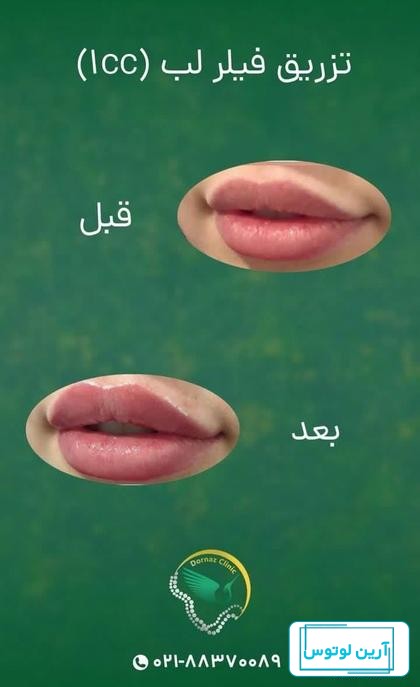 تزریق ژل لب | راهنمای 0 تا 100 [انواع ژل لب + مزایا و معایب]