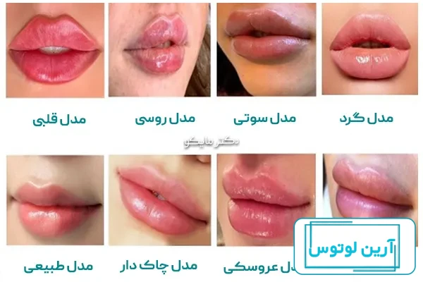 تزریق یک و نیم سی سی ژل لب کره ای ای.پی.تی.کیو به لب به فرم طبیعی (بلافاصله  بعد از تزریق) . ده روز بعد از تزریق ۳۰٪ از حجم به علت از