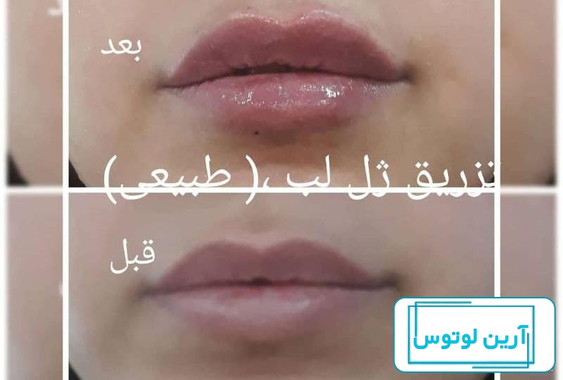 عکس تزریق ژل لب یک سی سی