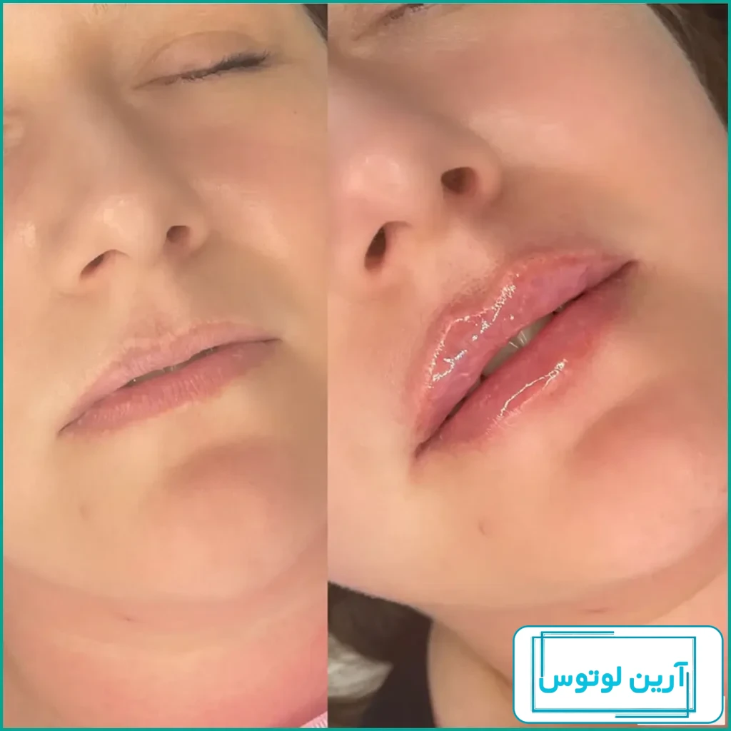 عکس تزریق ژل لب یک سی سی ❤️ - مرکز پوست مو و زیبایی درناز