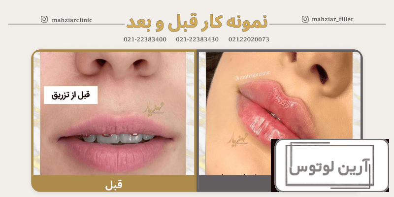 عکس قبل و بعد ژل لب نیم سی سی