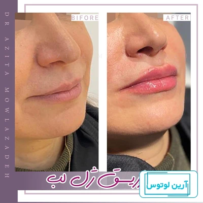 عکس ژل لب یک سی سی و تاثیر آن بر زیبایی لب‌ها ✔️ | مرکز زیبایی و لیزر