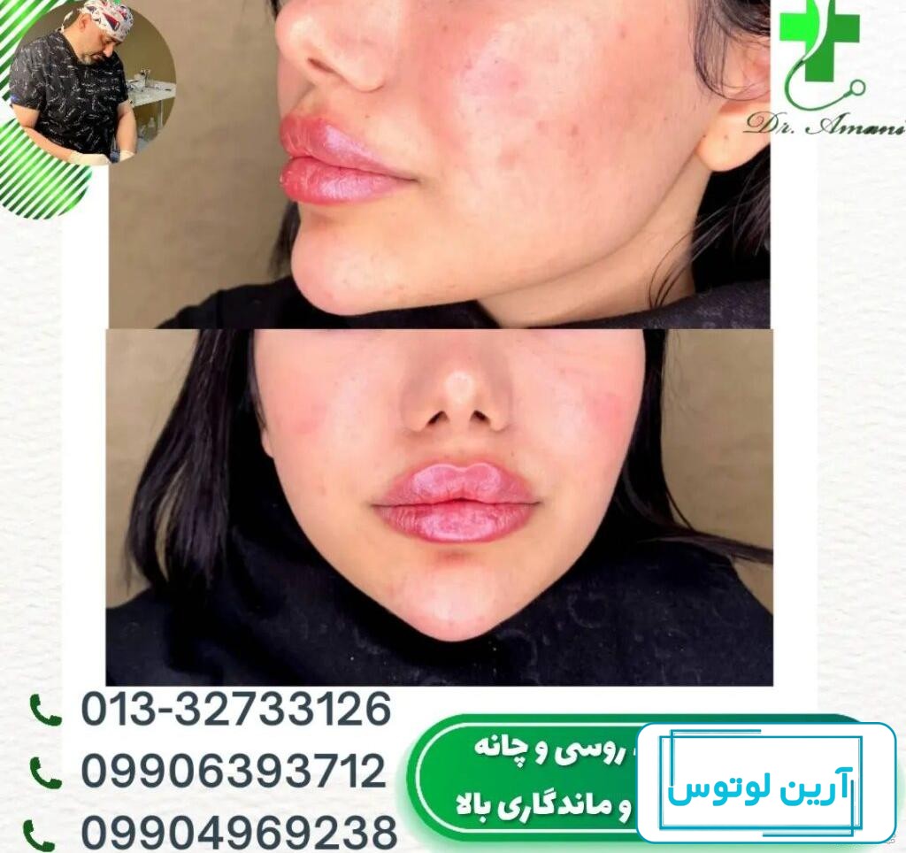 مراقبت های بعد از تزریق ژل لب
