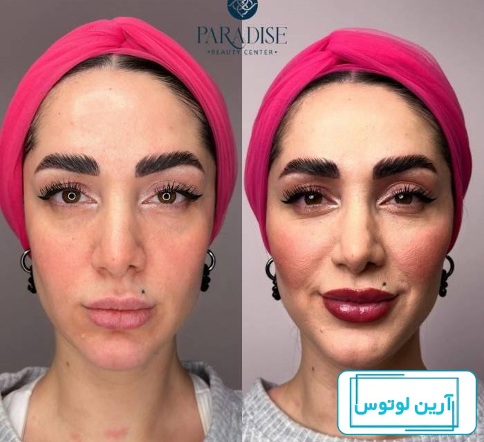 مقدار ژل مناسب برای لب : از نیم سی سی تا یک سی سی و بیشتر - مجله زیبایی  مهرزاد
