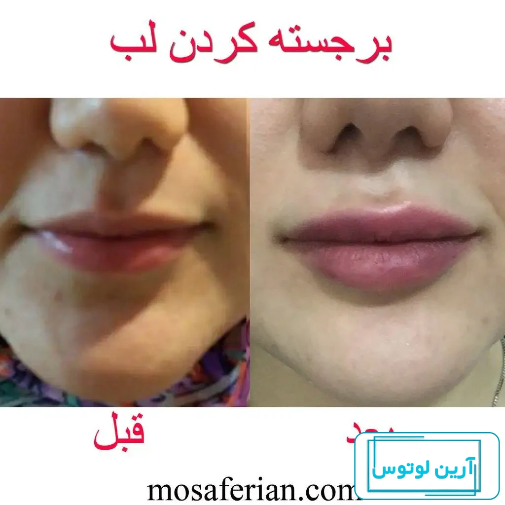 ژل لب طبیعی یا نچرال چیست؟ نحوه تزریق + ماندگاری و هزینه